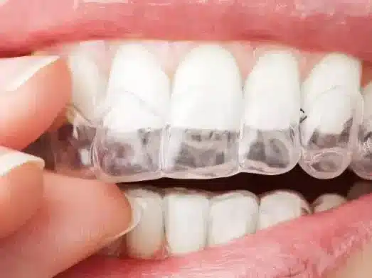 SG 牙齿矫正推荐